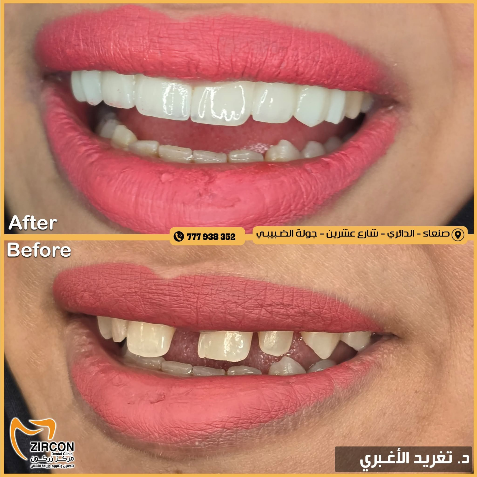 علاج التصبغات — نتائج علاج وتجميل الأسنان في مركز زركون قبل وبعد