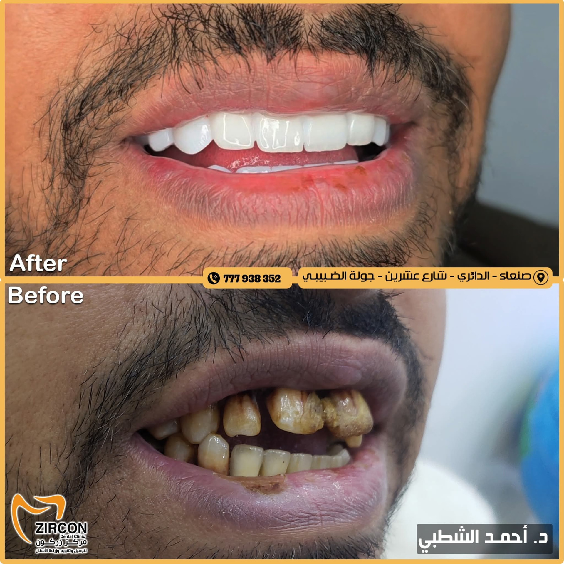 تجميل الأسنان العلوية — نتائج علاج وتجميل الأسنان في مركز زركون قبل وبعد