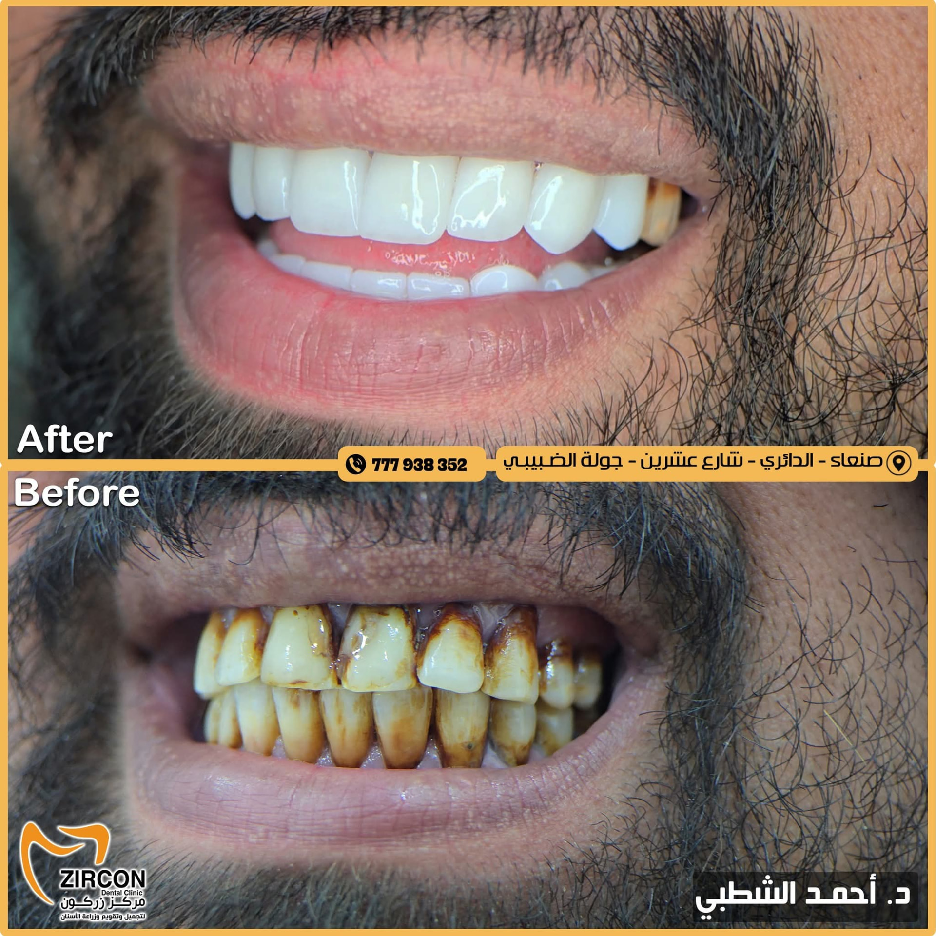 نتيجة نهائية — نتائج علاج وتجميل الأسنان في مركز زركون قبل وبعد