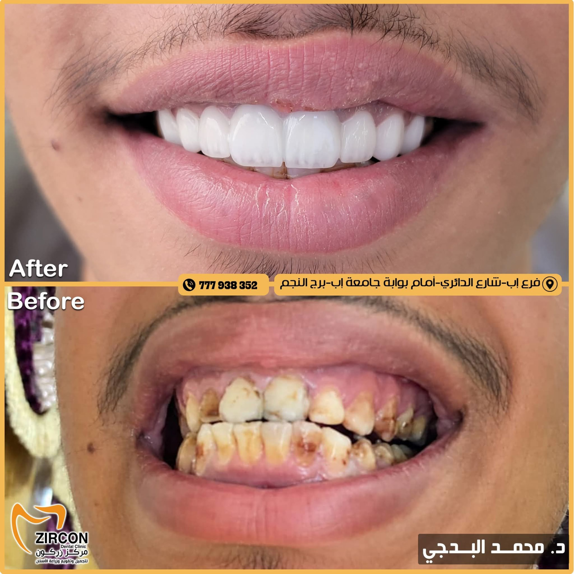تبديل تركيبات قديمة — نتائج علاج وتجميل الأسنان في مركز زركون قبل وبعد