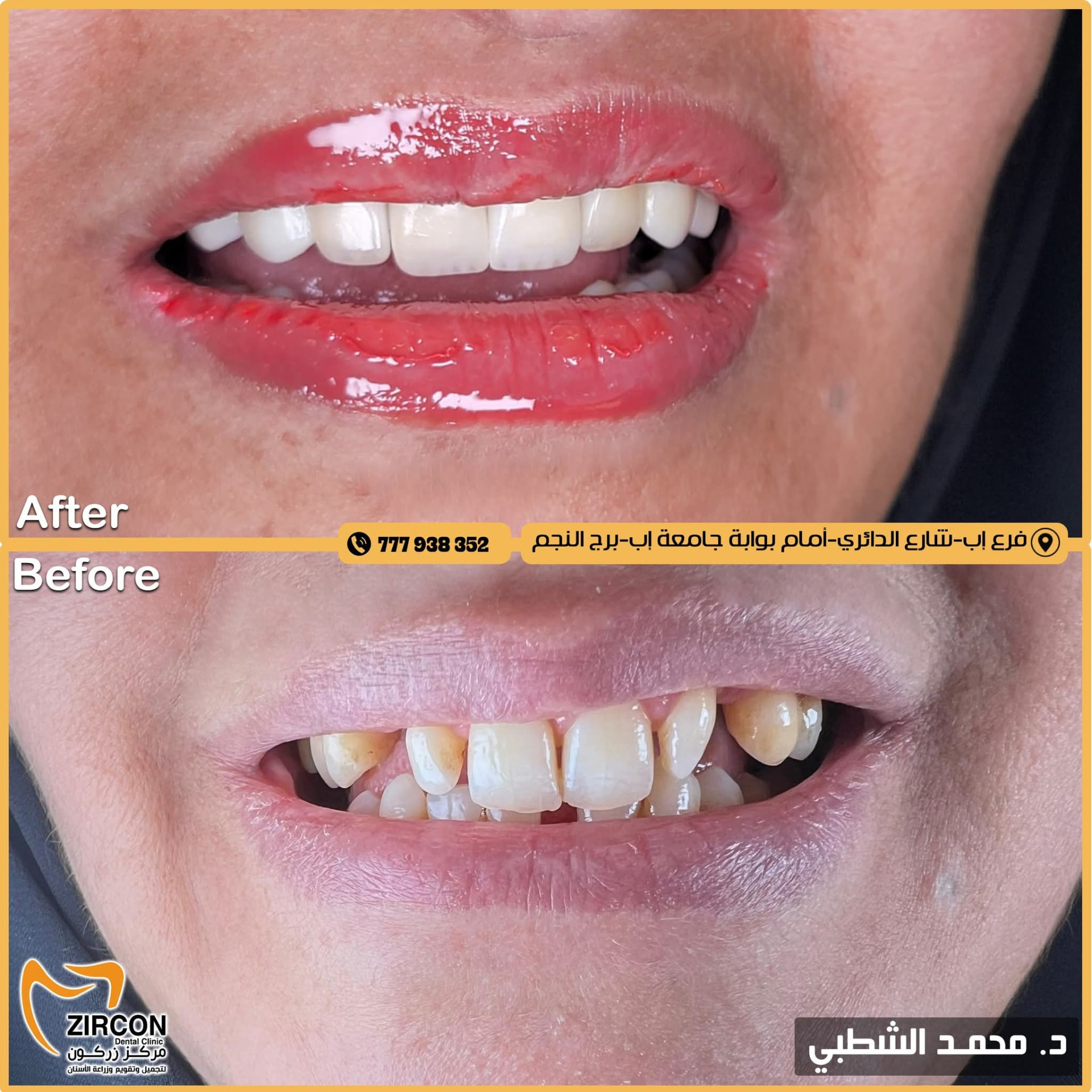 تركيبات ثابتة — نتائج علاج وتجميل الأسنان في مركز زركون قبل وبعد