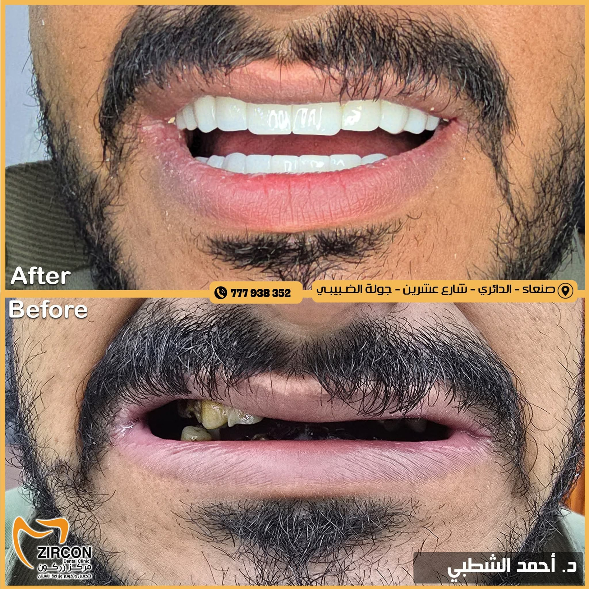 إصلاح تفاوت الأسنان — نتائج علاج وتجميل الأسنان في مركز زركون قبل وبعد