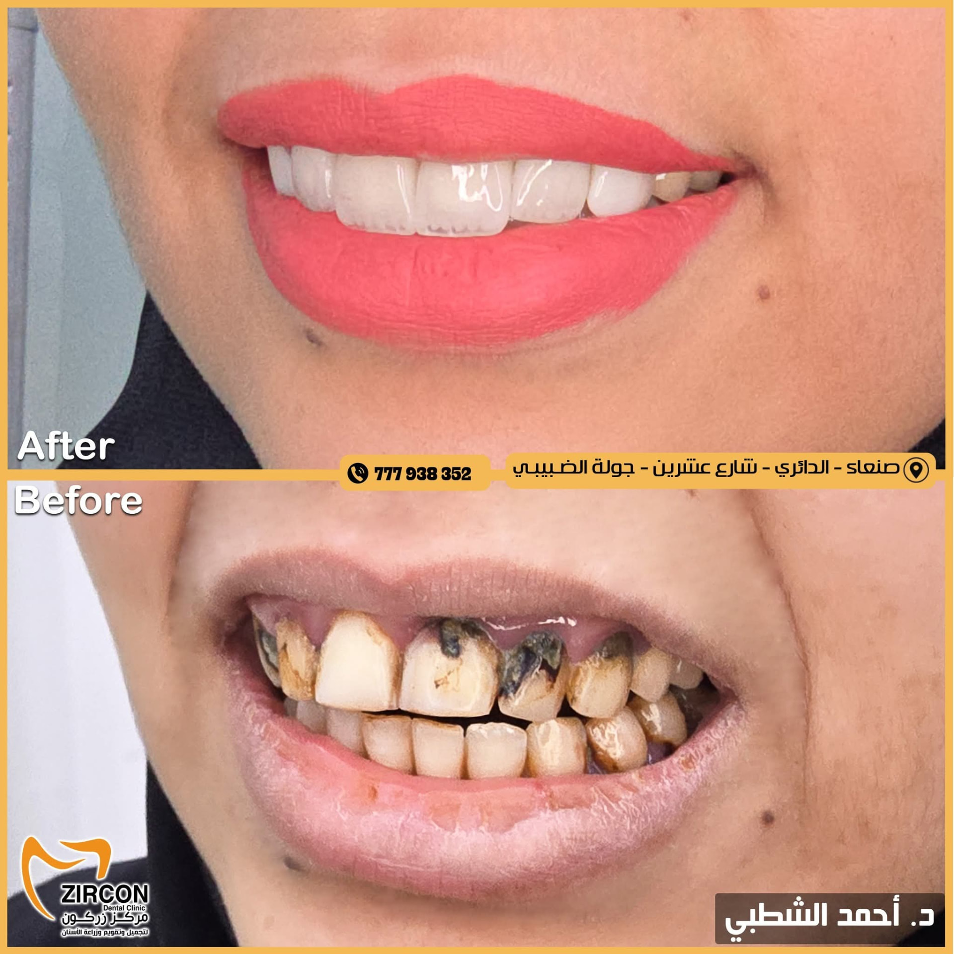 تصميم ابتسامة كامل — نتائج علاج وتجميل الأسنان في مركز زركون قبل وبعد