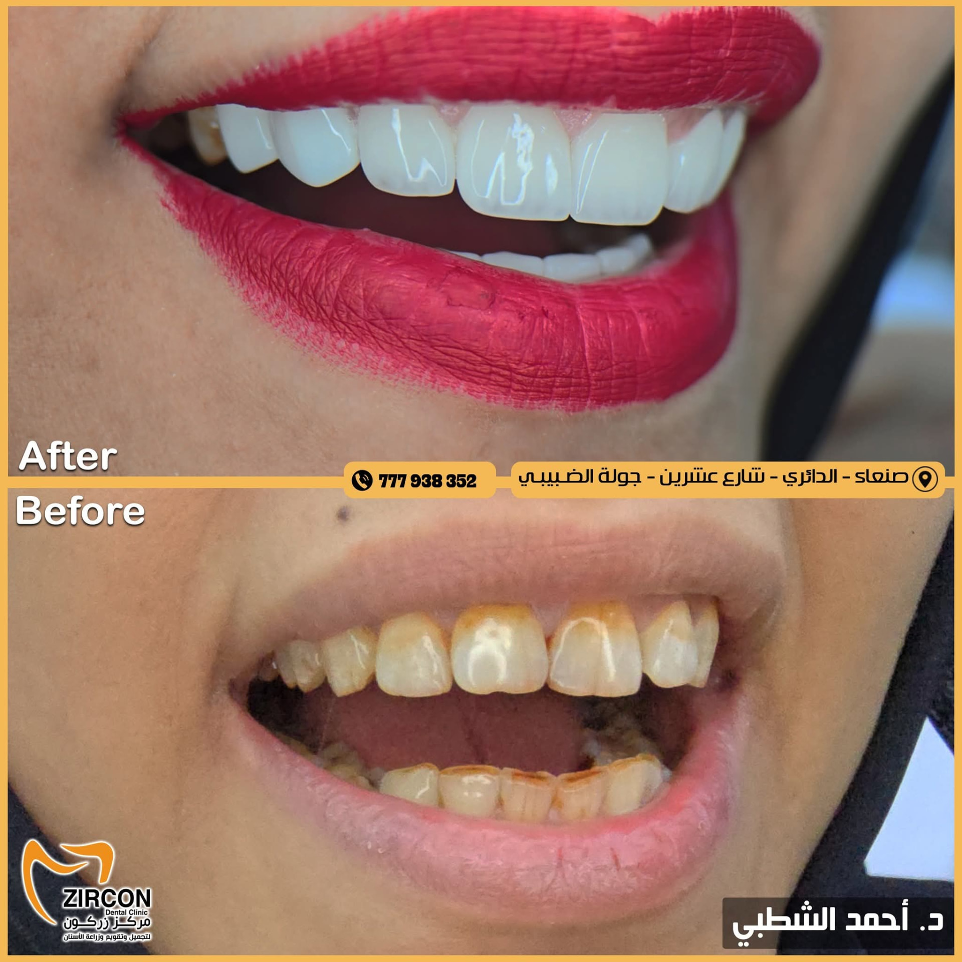 تجميل الأسنان الأمامية — نتائج علاج وتجميل الأسنان في مركز زركون قبل وبعد