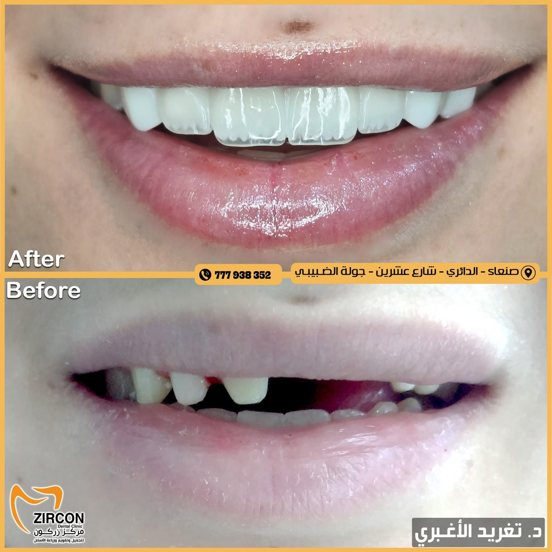 تحسين خط الابتسامة — نتائج علاج وتجميل الأسنان في مركز زركون قبل وبعد