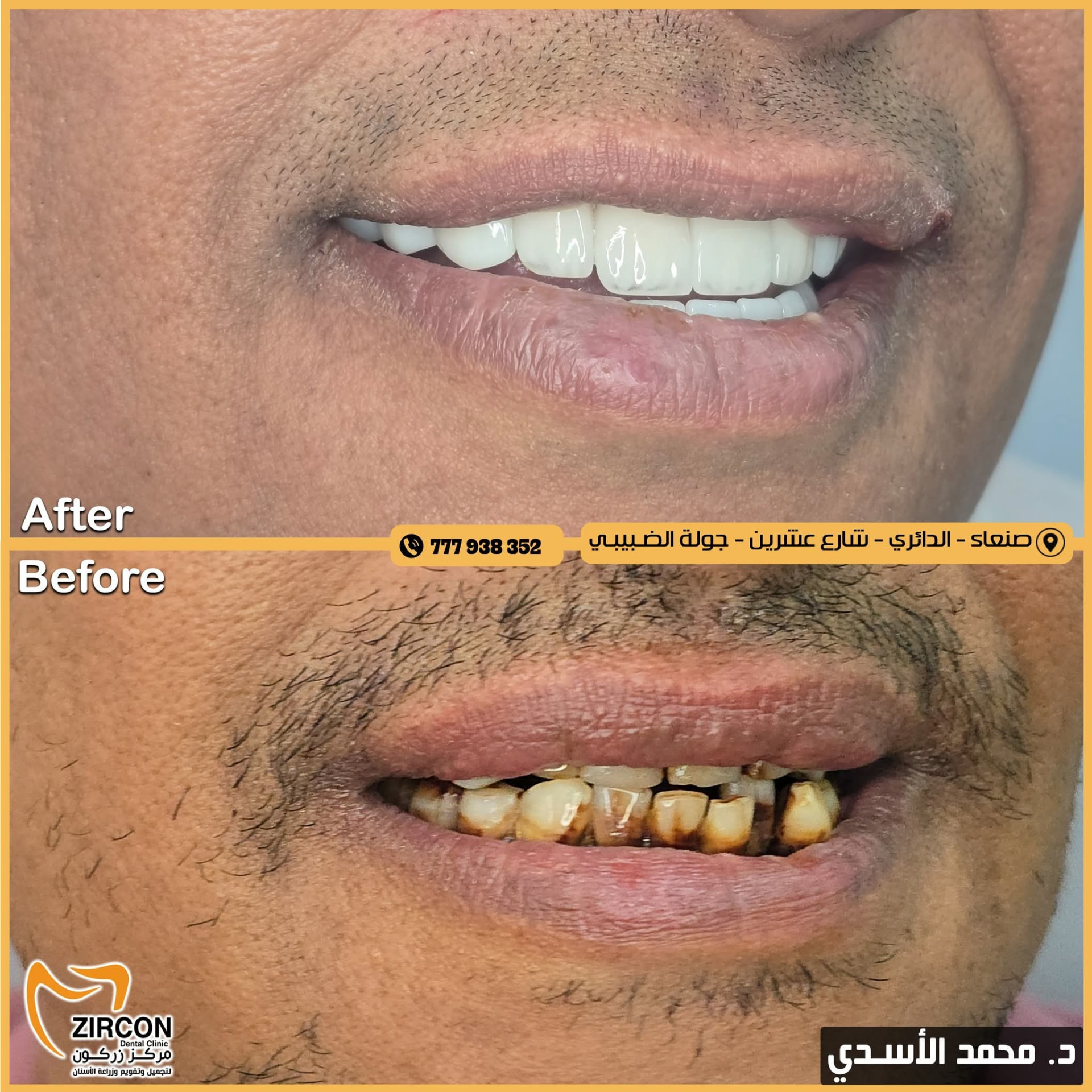 ابتسامة طبيعية — نتائج علاج وتجميل الأسنان في مركز زركون قبل وبعد