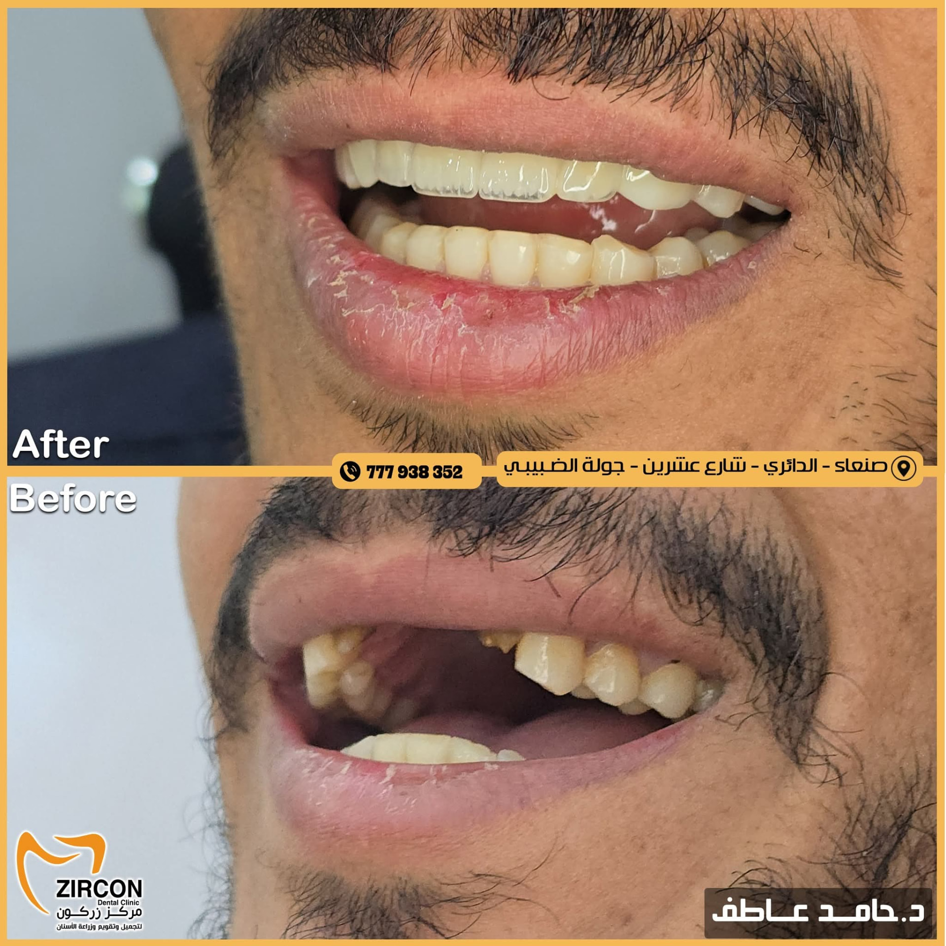 تقويم مظهر الأسنان — نتائج علاج وتجميل الأسنان في مركز زركون قبل وبعد