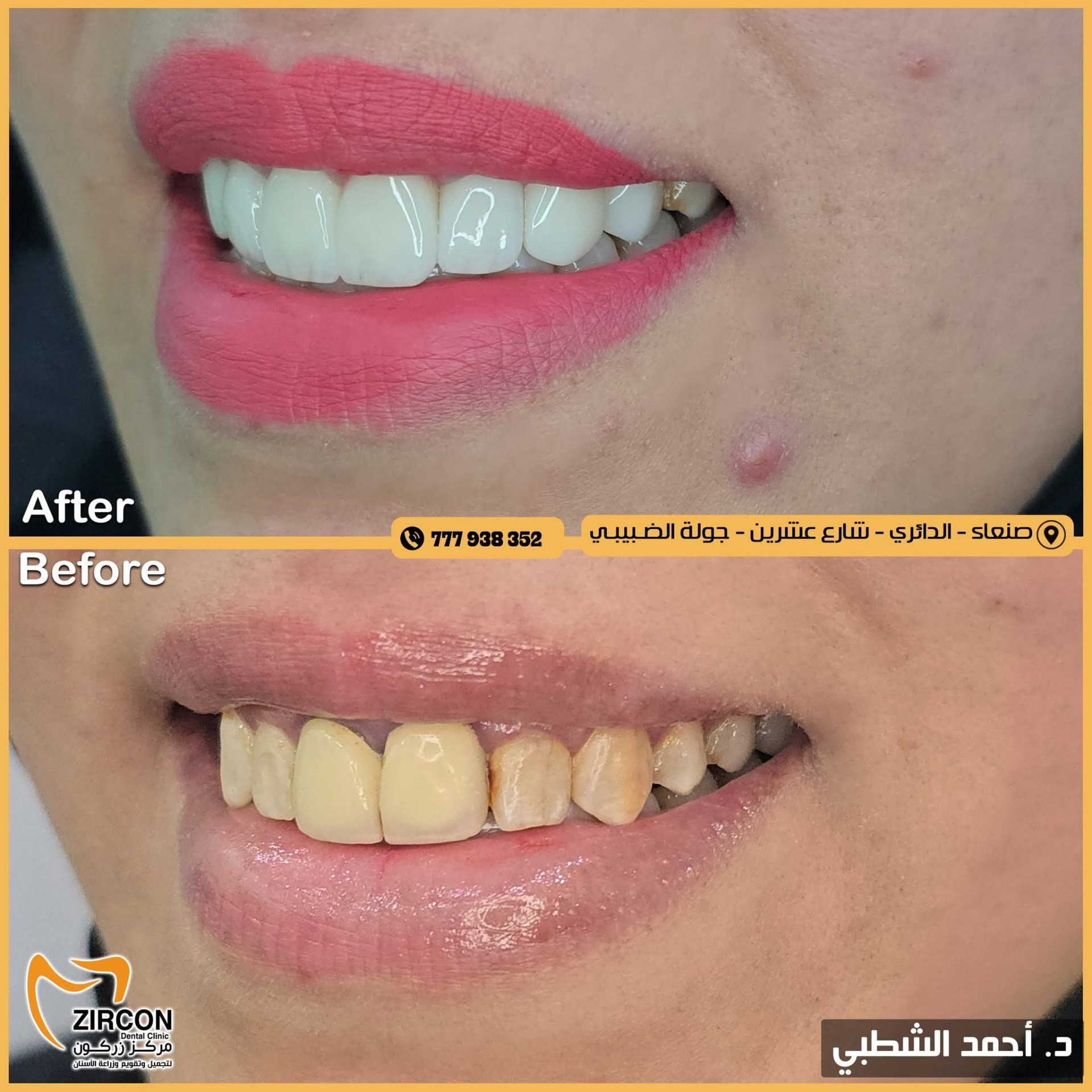 تعويض الأسنان المفقودة — نتائج علاج وتجميل الأسنان في مركز زركون قبل وبعد