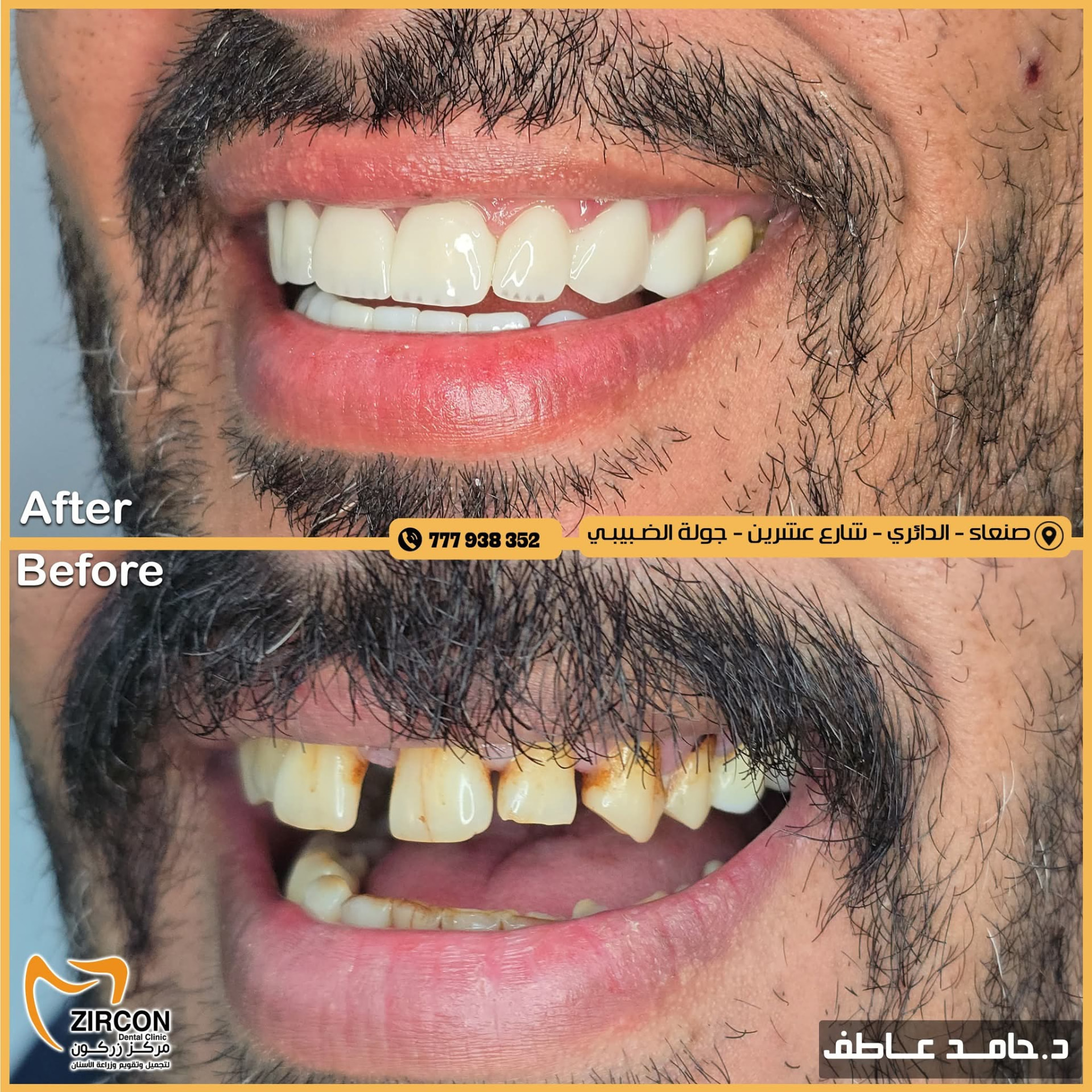 ترميم الأسنان المتكسرة — نتائج علاج وتجميل الأسنان في مركز زركون قبل وبعد