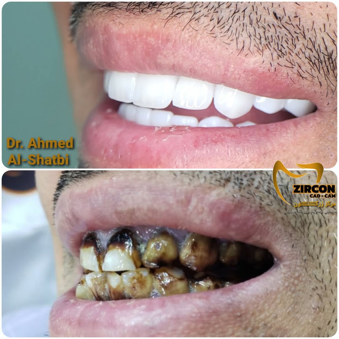 ابتسامة هوليوود — نتائج علاج وتجميل الأسنان في مركز زركون قبل وبعد