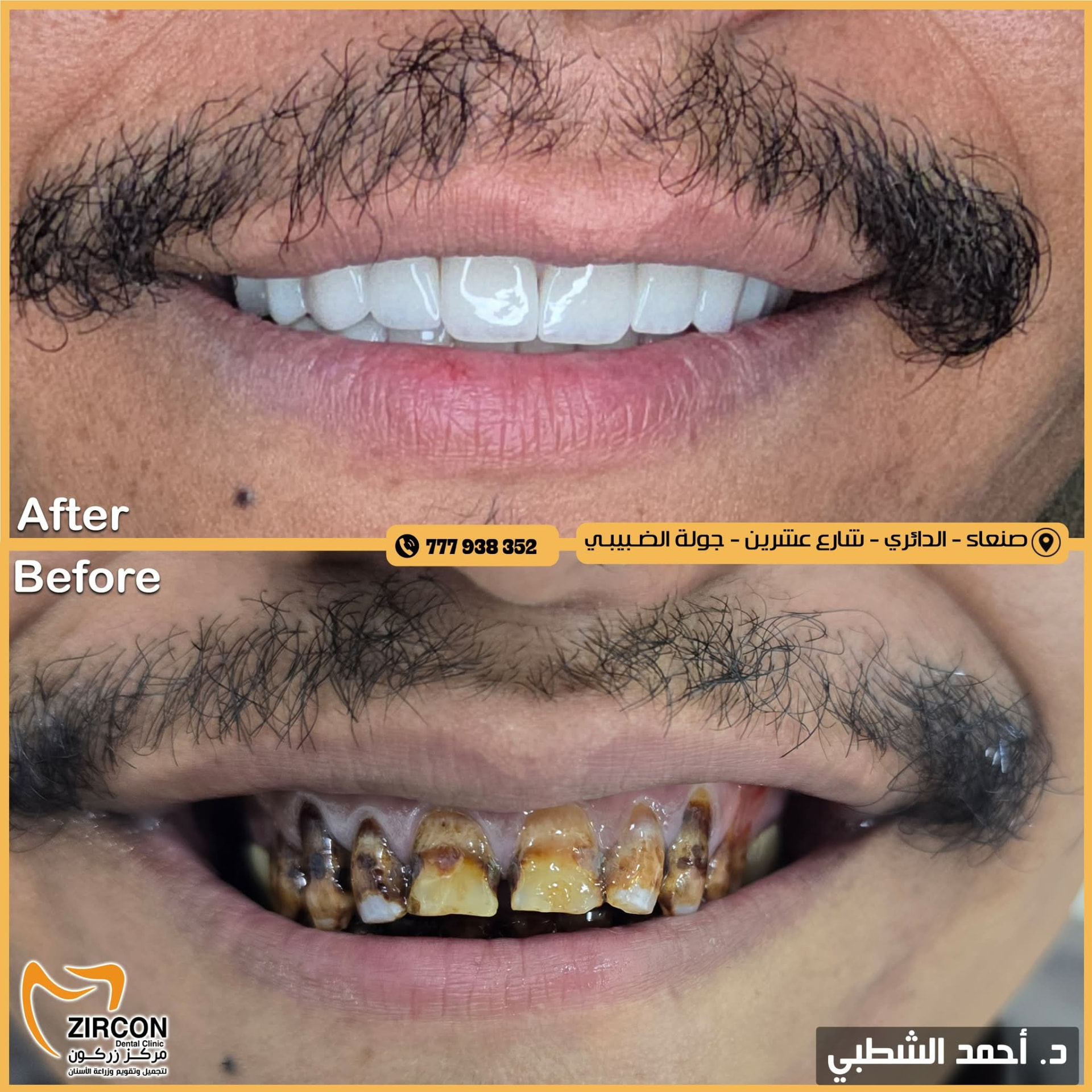 زيركون كامل الفم — نتائج علاج وتجميل الأسنان في مركز زركون قبل وبعد