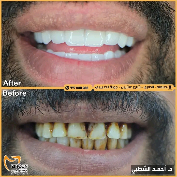 حالة قبل وبعد — نتائج علاج وتجميل الأسنان في مركز زركون قبل وبعد