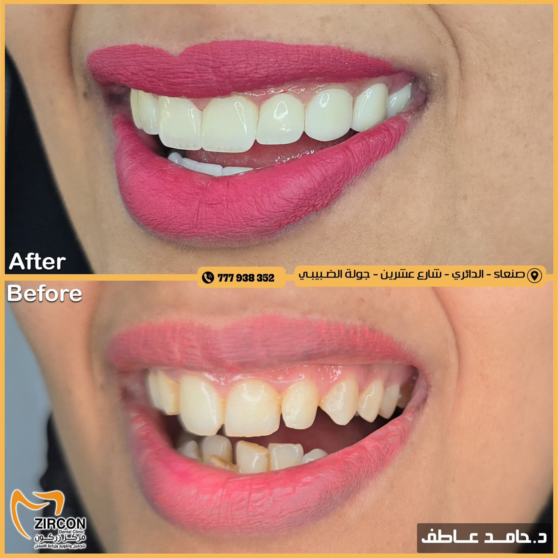 معالجة الفراغات — نتائج علاج وتجميل الأسنان في مركز زركون قبل وبعد