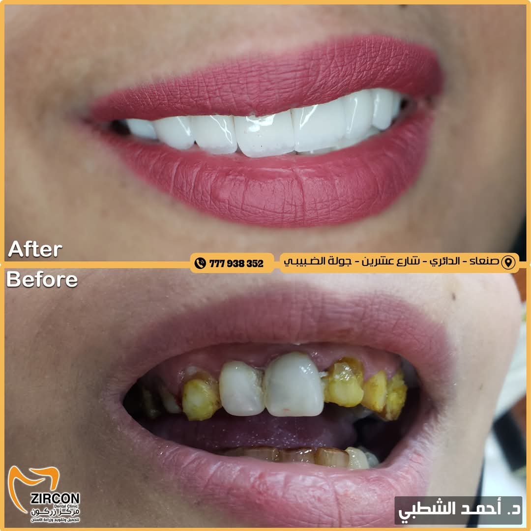 إعادة تأهيل الفم — نتائج علاج وتجميل الأسنان في مركز زركون قبل وبعد