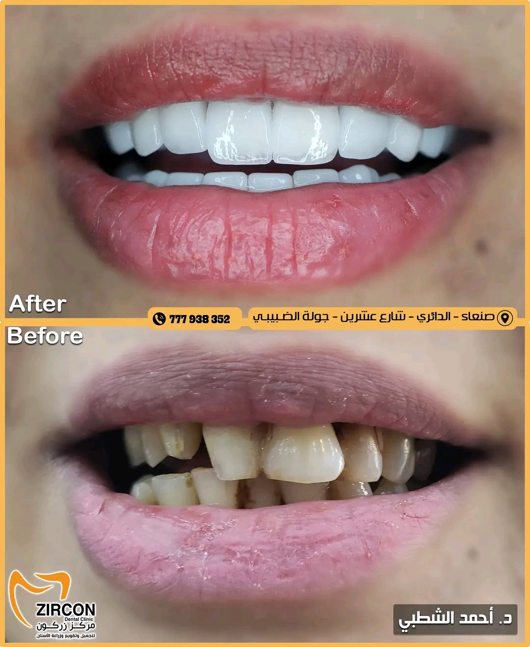 علاج وتجميل متكامل — نتائج علاج وتجميل الأسنان في مركز زركون قبل وبعد